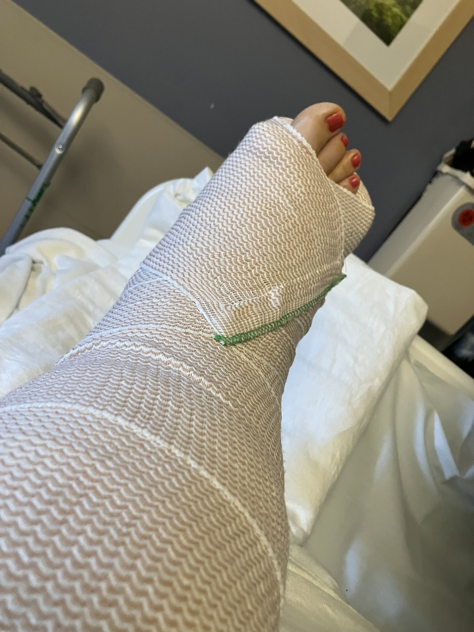 photo of a leg in a big bandage at the hospital