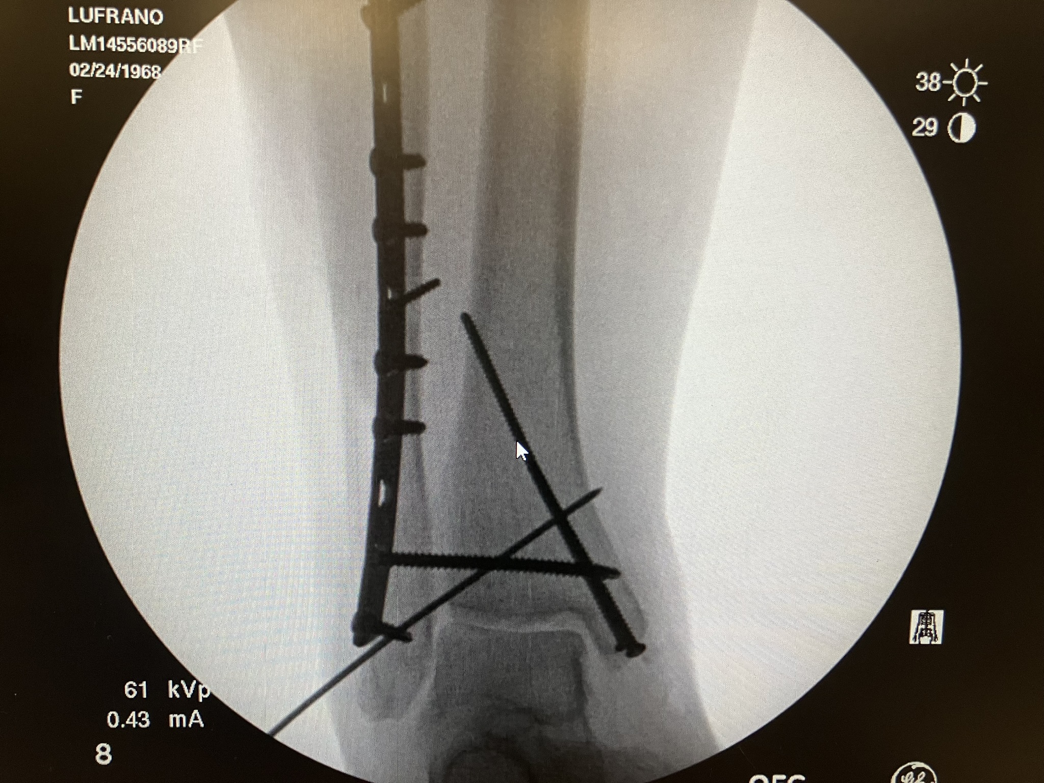 xray of fractured ankle and leg repairs with plates and screws