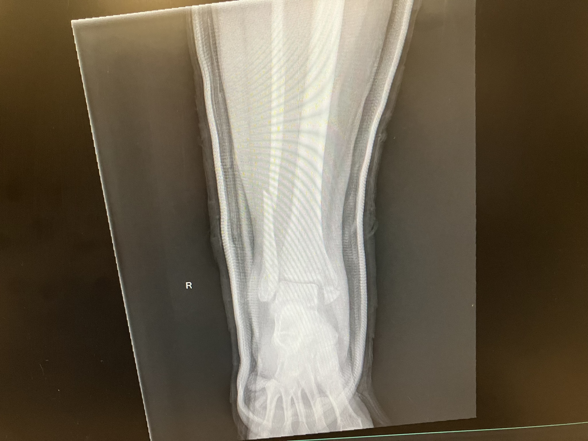 xray of fractured ankle and leg